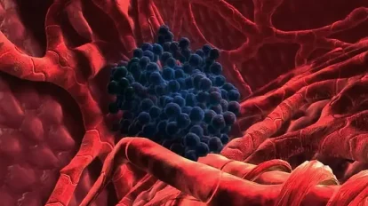 Cáncer de hígado