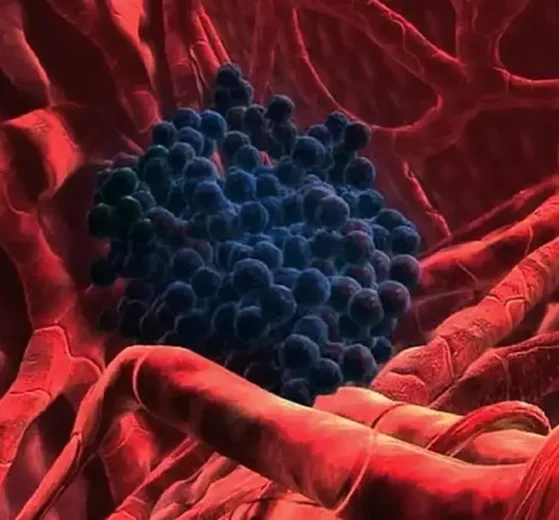 Cáncer de hígado