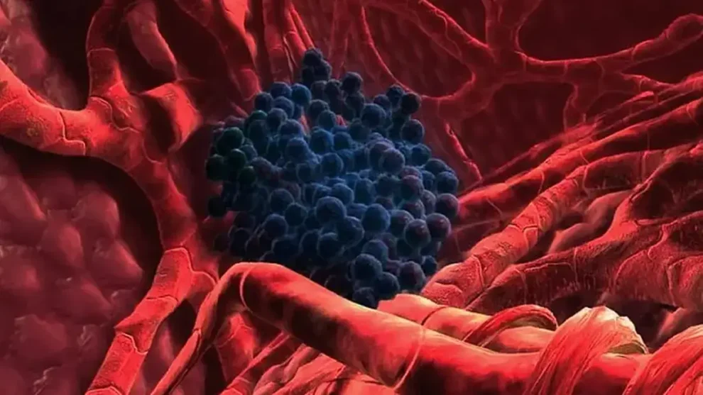 Cáncer de hígado